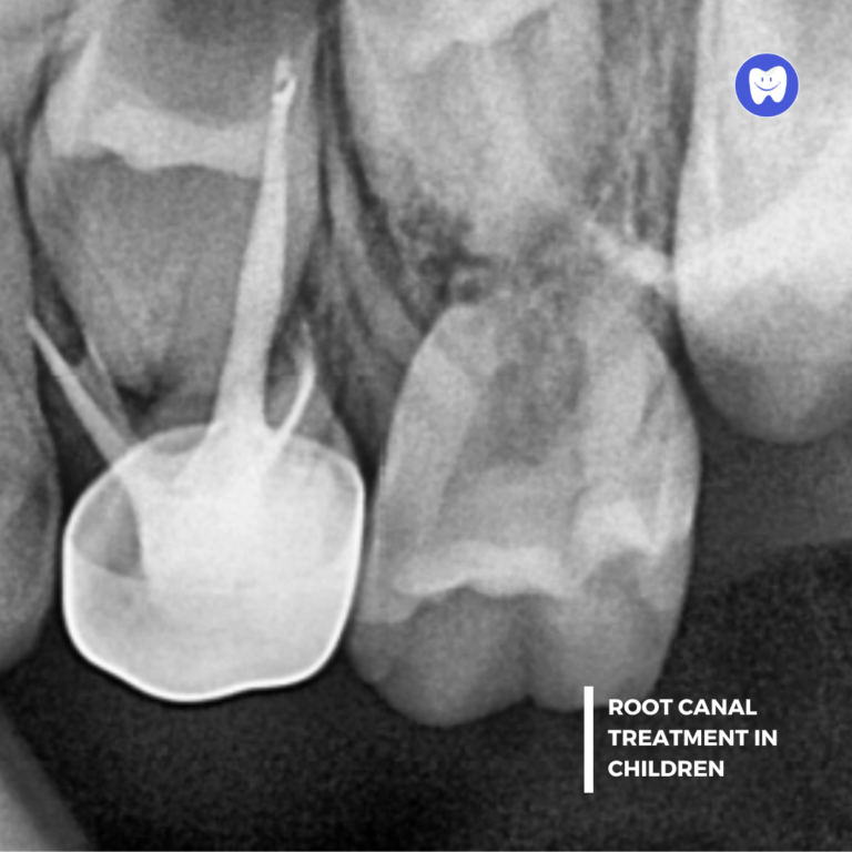 Panth xray Upper - Copy